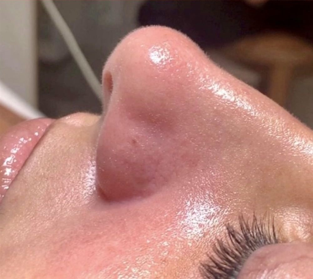 Pele depois da limpeza de pele profissional